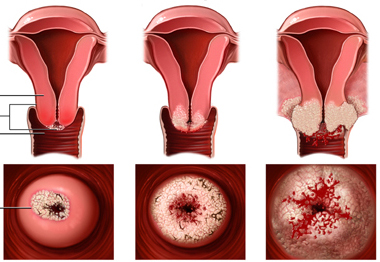 Viêm cổ tử cung là bệnh gì?