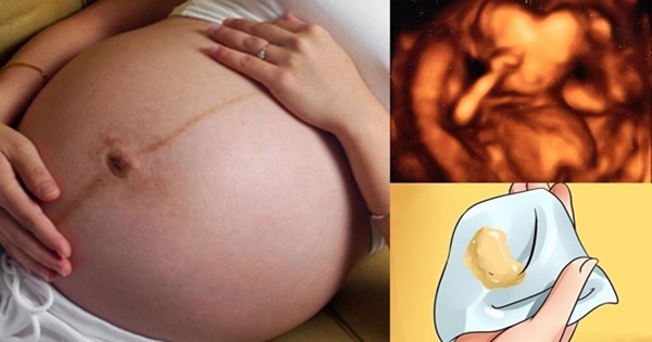 Khí hư dấu hiệu mang thai