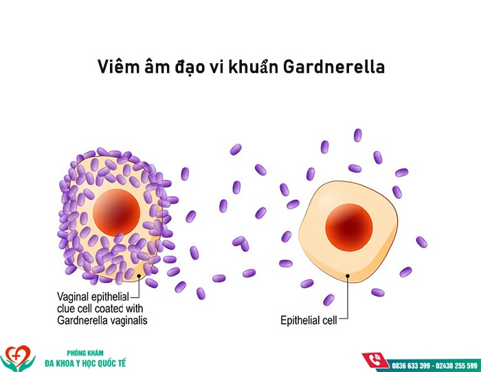 Viêm âm đạo vi khuẩn gardnerella